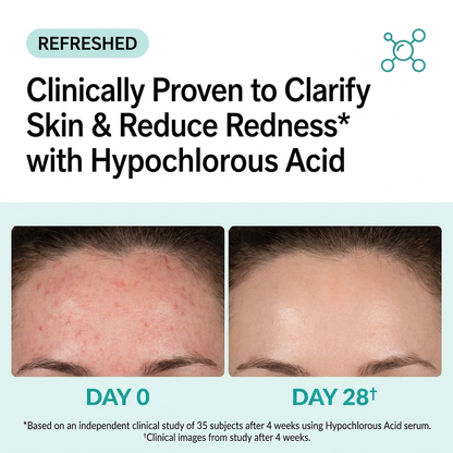Hypochlorous Acid for Acne