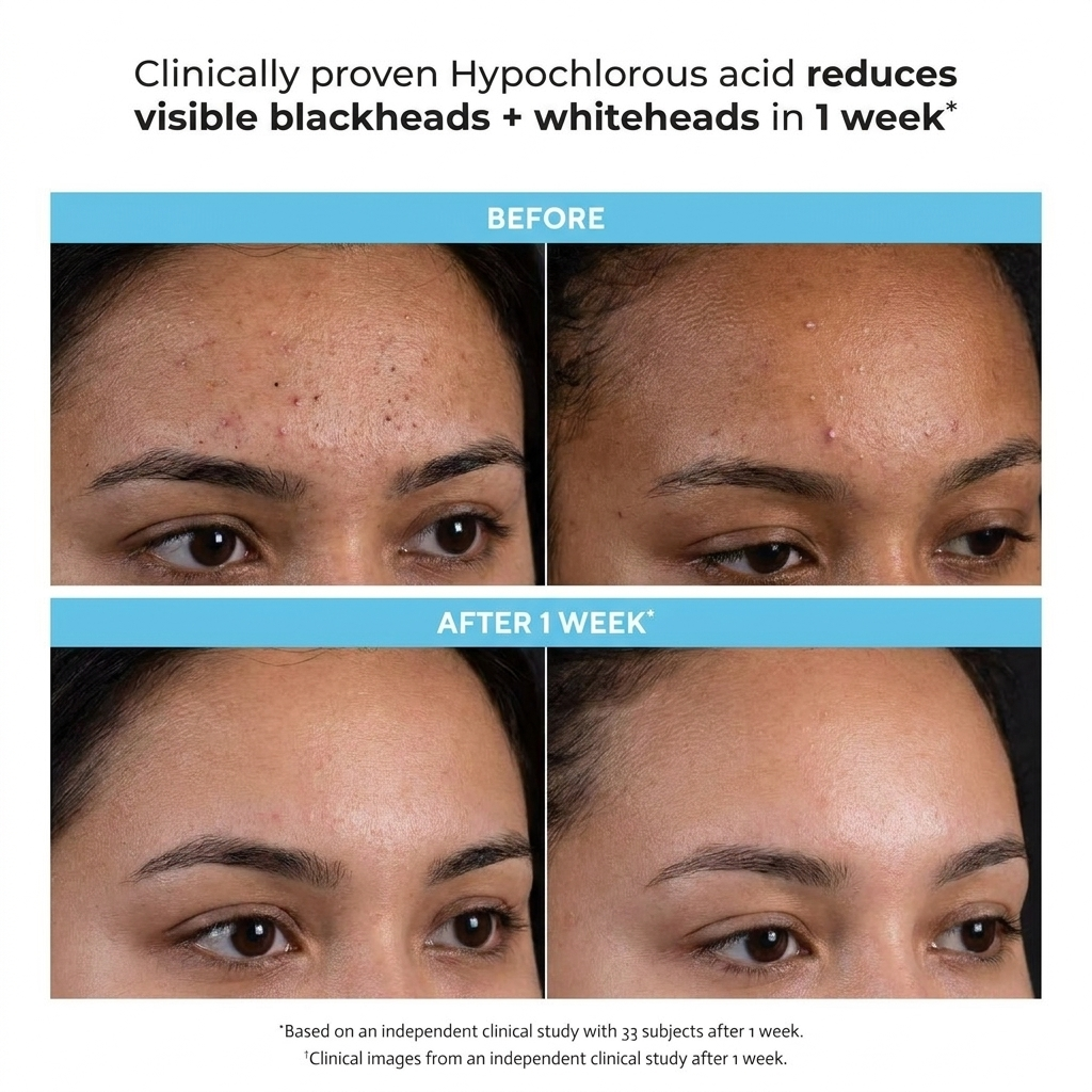 Hypochlorous Acid for Acne