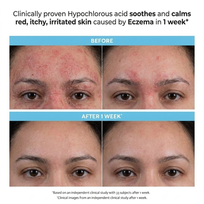 Hypochlorous Acid for Eczema