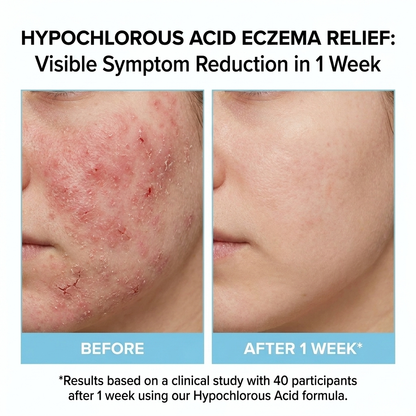 Hypochlorous Acid for Eczema